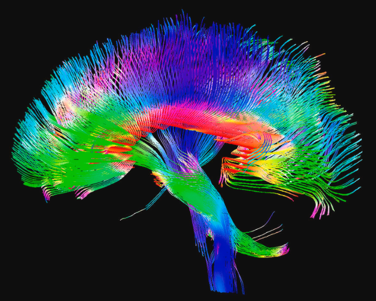 AI Algorithm Enables Tracking of Vital White Matter Pathways