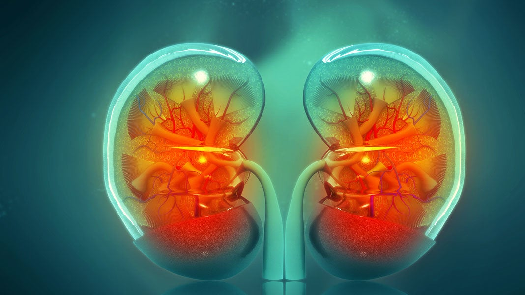 AI Helps Detect Kidney Cancer Faster